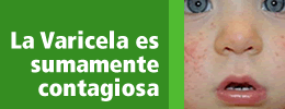 La Varicela es sumamente contagiosa
