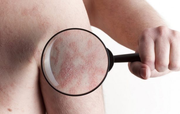 Todo lo que debes saber sobre <br> la dermatitis atópica